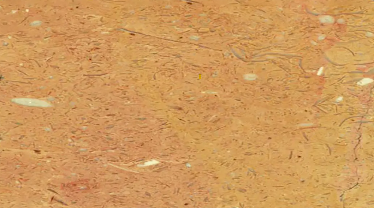 مرمریت گندمک